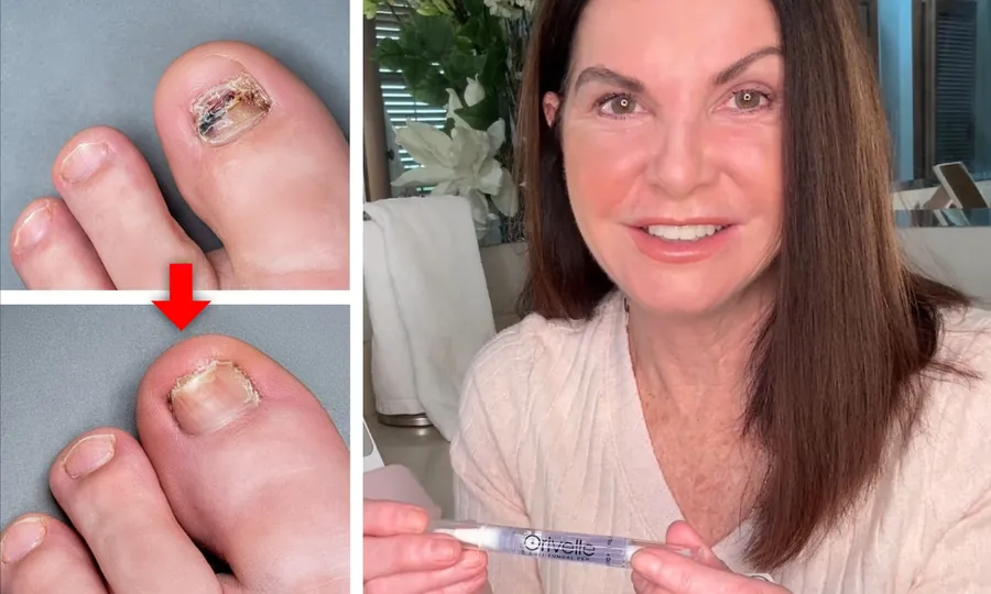 Toenail before and after treatment
