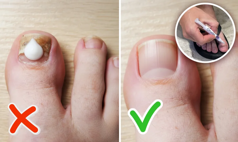 Cream sitting on top of the nail versus precision pen application