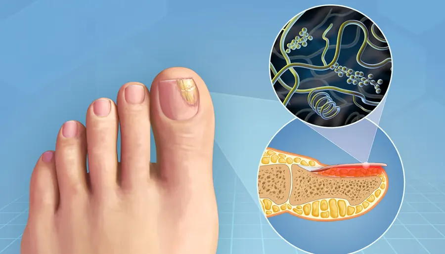 Diagram showing fungal colony sitting beneath the nail plate