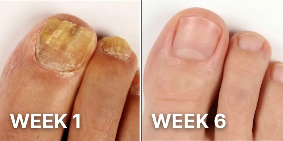 Same toenail at week one and week six