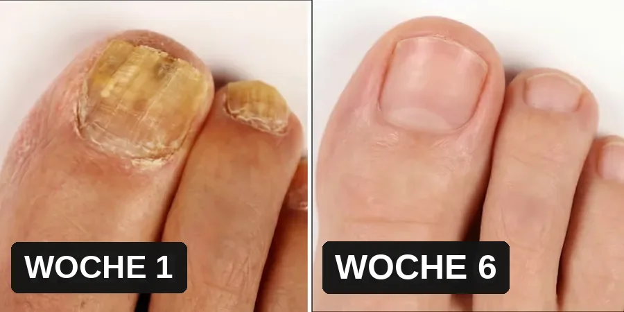 Derselbe Zehennagel in Woche eins und in Woche sechs